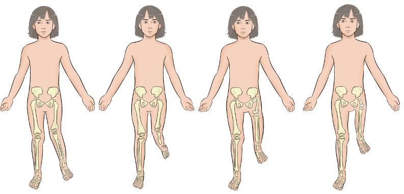 Deformidades Congénitas. Hipoplasia Postaxial de las extremidades inferiores.